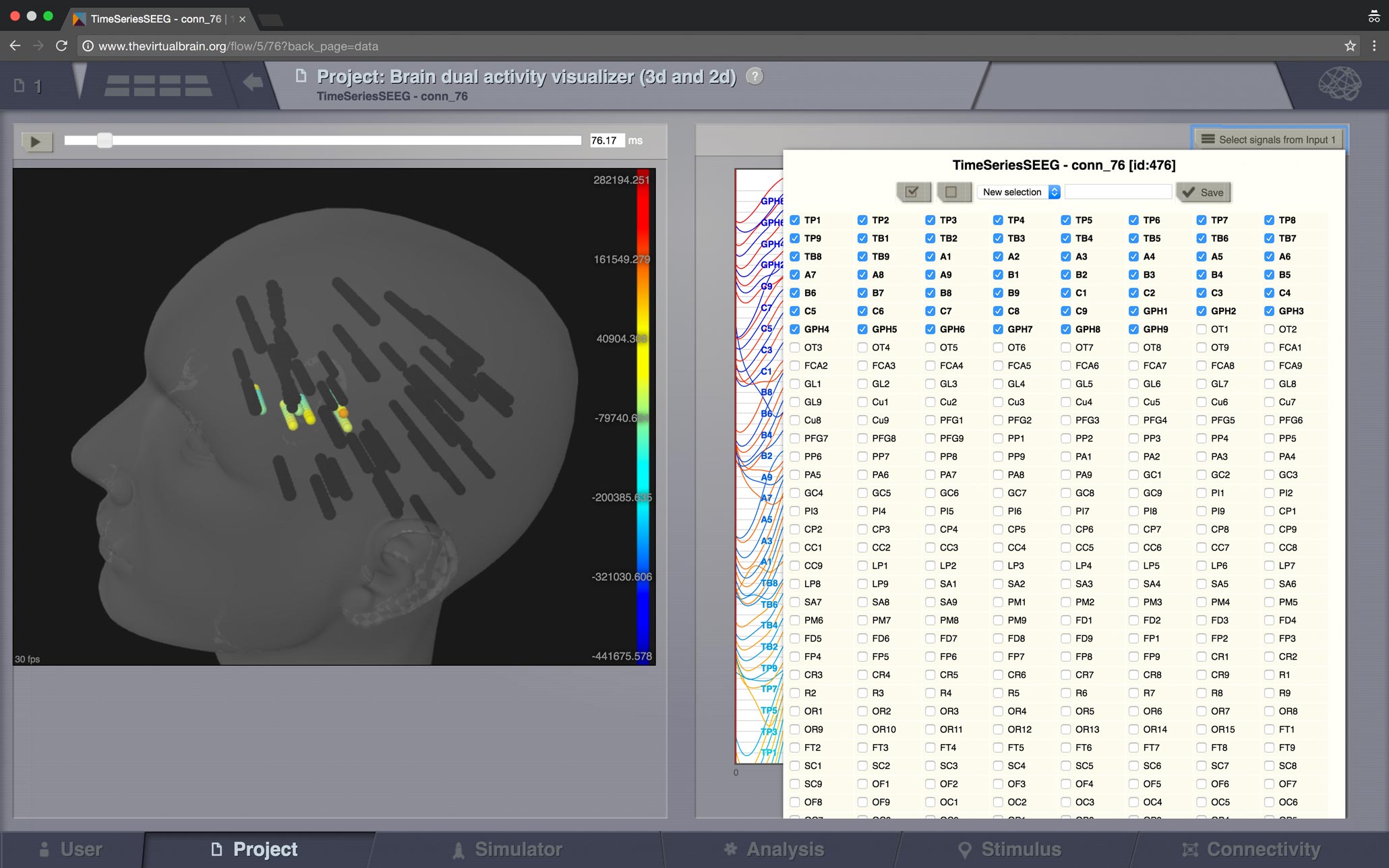 ViewBrainActivity_SEEG.jpg